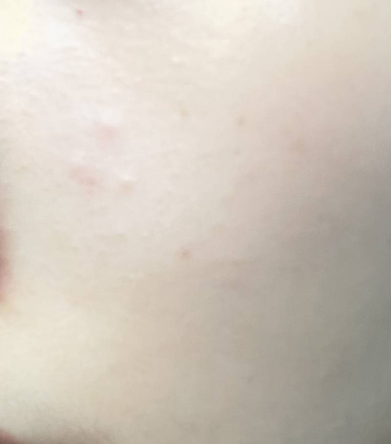 갑자기 피부에 이런 것들이 막 나서 피부과 가서 후딱 해치우고 싶은데ㅠㅠ | 인스티즈