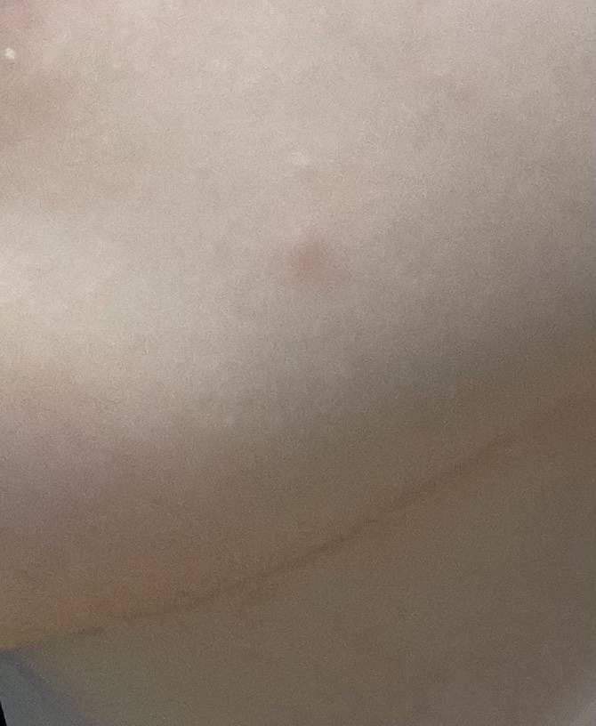 갑자기 피부에 이런 것들이 막 나서 피부과 가서 후딱 해치우고 싶은데ㅠㅠ | 인스티즈