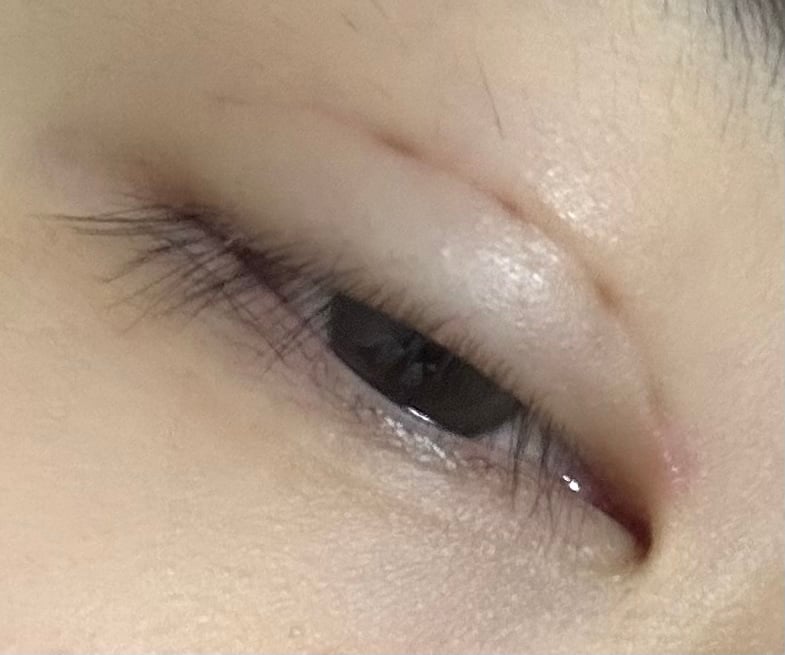 쌍수한 익들아 이런 바느질자국 나중 가면 없어져?? | 인스티즈