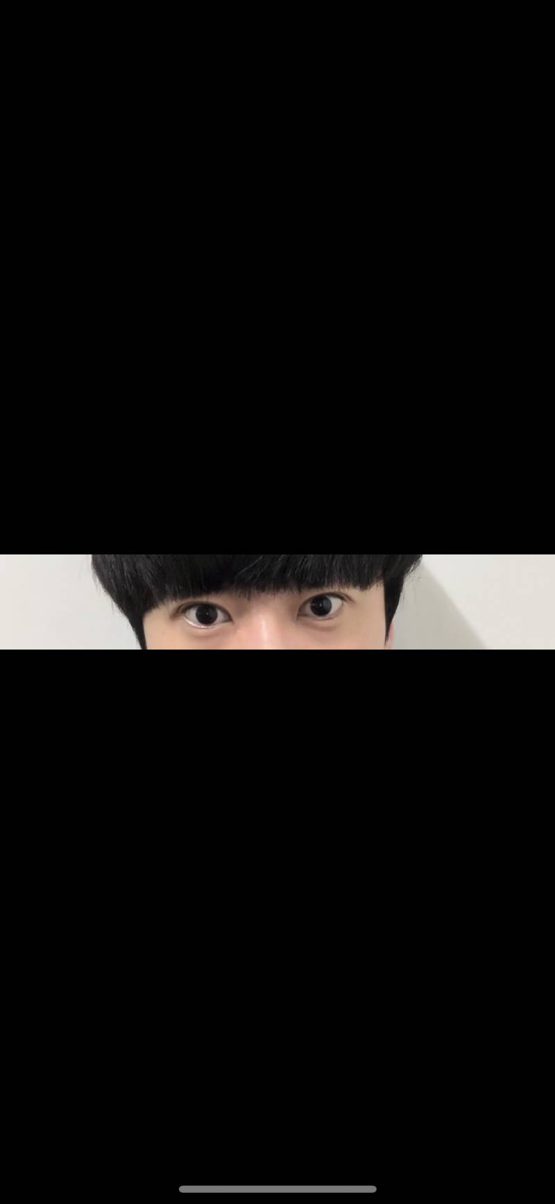 쌍수 앞트임한지 2달째인데 눈 짝짝이 맞는거 같에? ㅠㅠ 왼쪽 눈만 재수술 할지 생각중이야 | 인스티즈