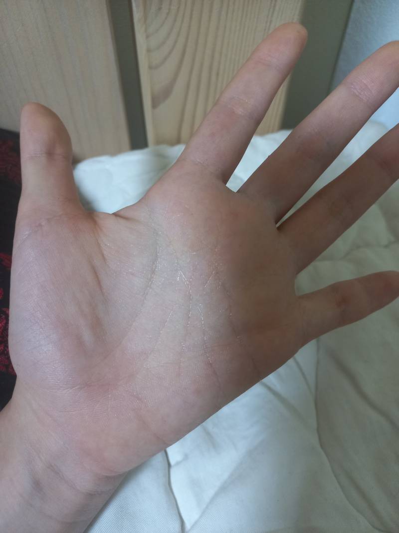 여기 다한증이나 손에 땀 많이나는 익 있어?? | 인스티즈