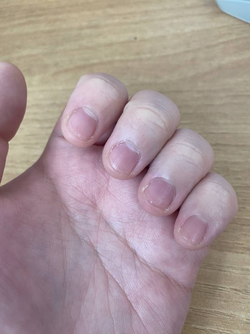 나 손톱이 이렇게 짧은데 (이로 뜯어서) 여기에 그냥 네일 얹어도 되나? | 인스티즈