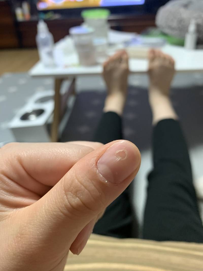 나 손톱에 구멍? 났을 때 구멍이 점점 올라가는 과정.. | 인스티즈