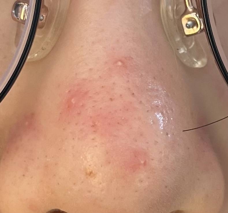 이런 여드름 약 먹어서 나아본 사람 진짜 적나라한 사진있음!!!!!!! 블랙헤드도 개쩌는데 화질좋아서 개 더러움 (혐오주의) | 인스티즈