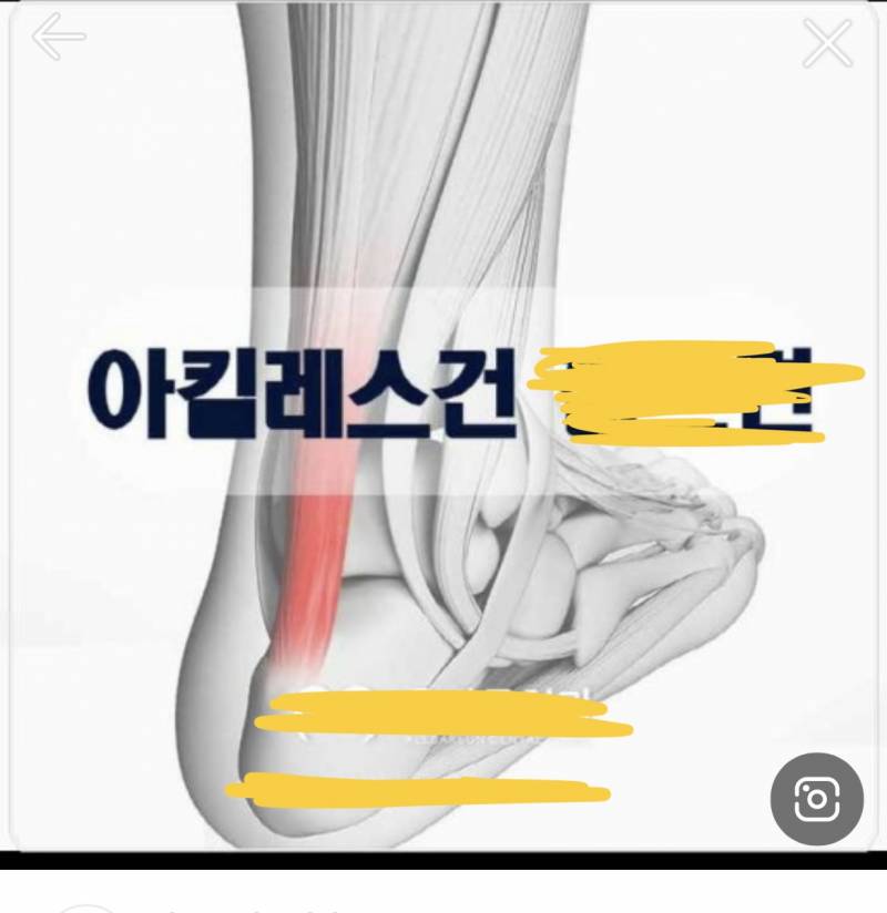 익들아ㅜㅜ 나 갑자기 아킬레스건이 아픈데 필테 햄스트링? 스트레칭 자세 심하게 하면 원래 아파ㅠㅠㅠ?? | 인스티즈
