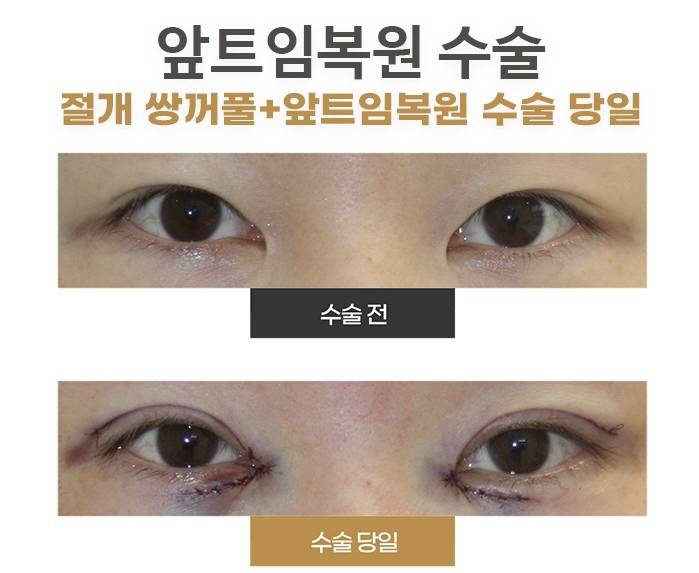 혹시 여기 성형잘알들아 이정도로 절개하는거 정상이야????‼️ | 인스티즈