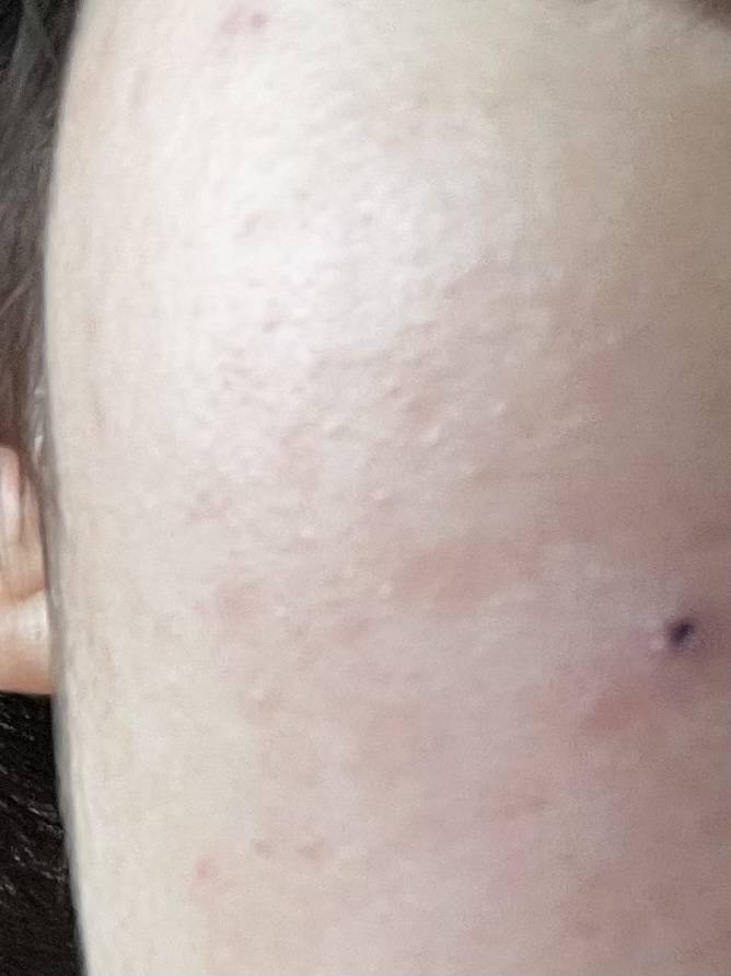 얼굴에 작게 오돌토돌 이거 대체 뭐임 어떻게 없애? 학생이라 피부과 치료는 부담인데 피지억제제약은 먹고있긴해 | 인스티즈