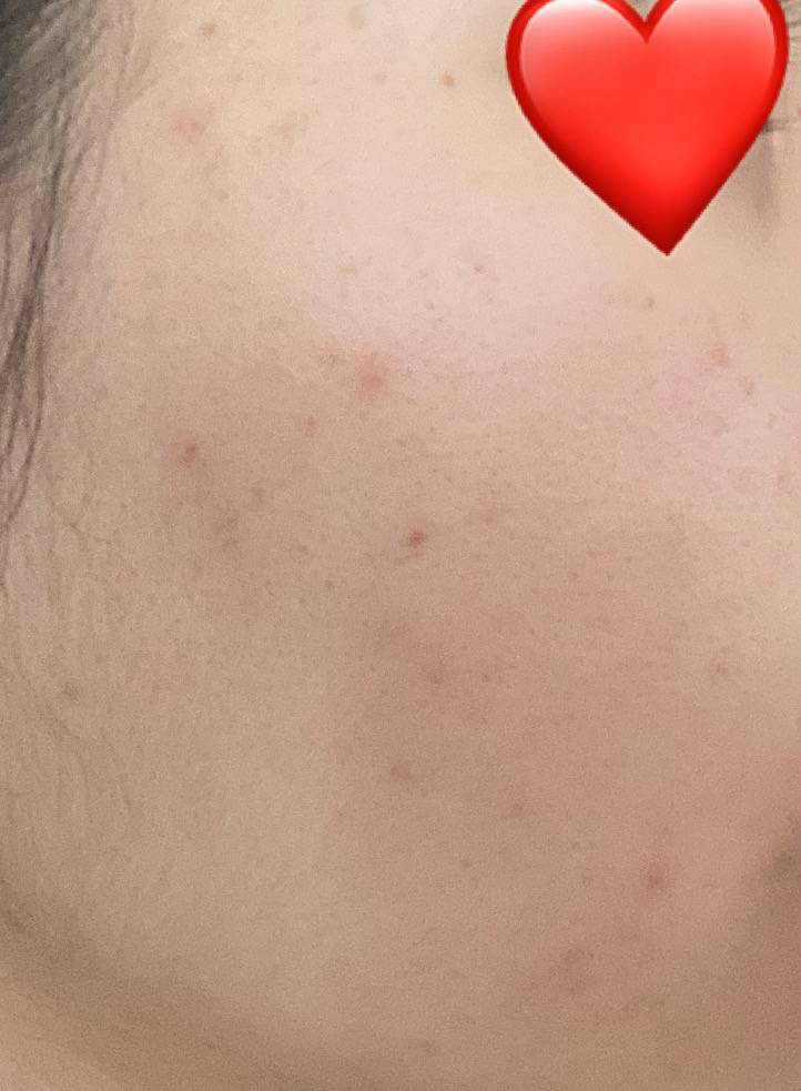 ㅎㅇㅈㅇ) 이런 좁쌀 여드름들 처리하는 방법 아는 사람ㅠㅠ 피부과말고.. | 인스티즈