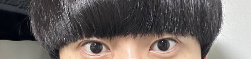 눈만 봤을때 짝눈 재수술해서 교정하는게 나을꺼 같아?? | 인스티즈