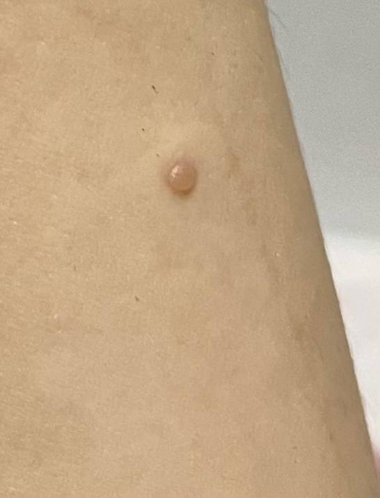 팔에 이런 물집?이 작게 잡혔는데 뭐지ㅠㅠ | 인스티즈
