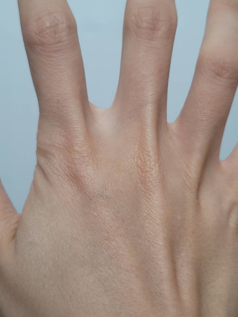 왼손검지 꺽여서 부었는데 병원가야하나!!! | 인스티즈