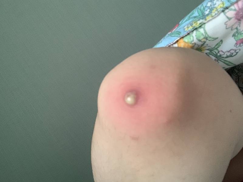팔꿈치에 뭐가 생겼는데 뭘까?... | 인스티즈