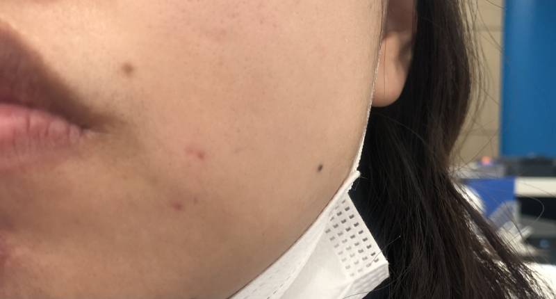 이런 여드름 흉터는 어떻게 관리해야할까 | 인스티즈