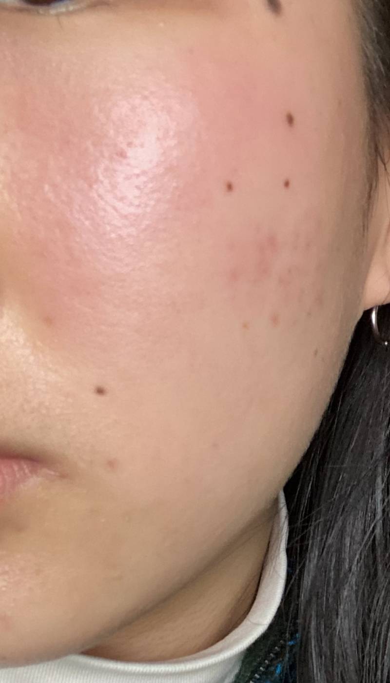 (혐오주의)피부가 갑자기 부어올랐어요ㅠㅠㅠㅠ | 인스티즈