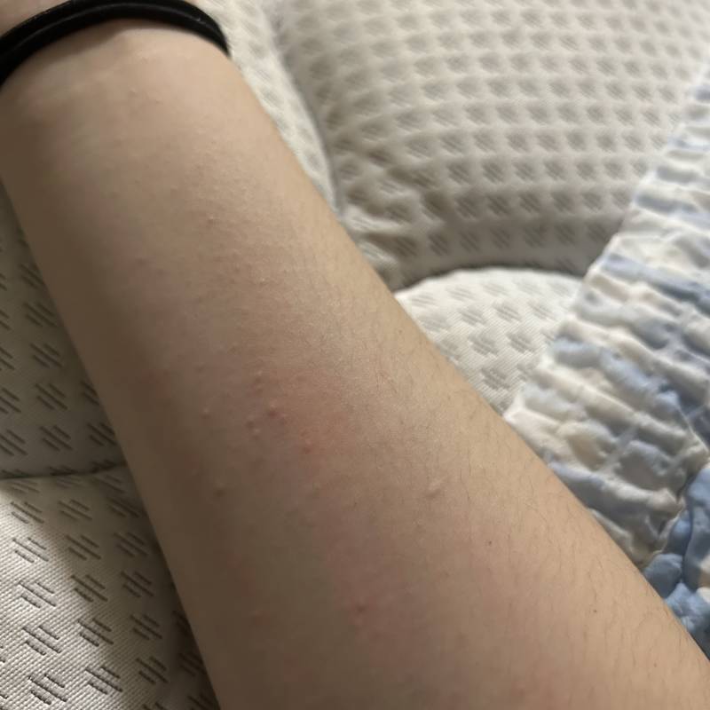 팔에 뭐가 났는데... 좀 가려워서ㅠㅜ 혹시 먼지 아는 사람 (혐오주의) | 인스티즈