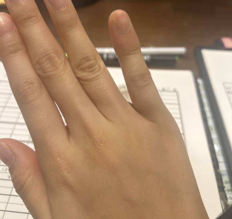 [잡담] 얘들아 새끼손가락 부었는데 | 인스티즈