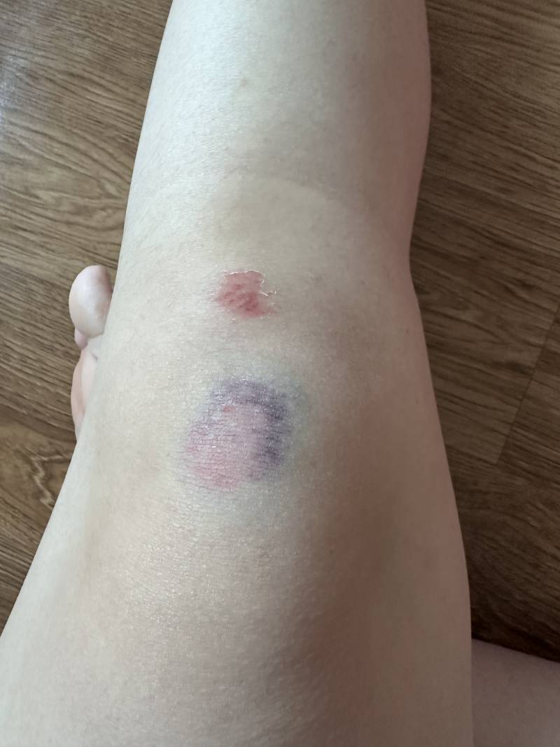 [잡담] 오늘 다쳐서 이렇게 되었는데 내일 운동 취소?(ㅎㅇㅈㅇ) | 인스티즈