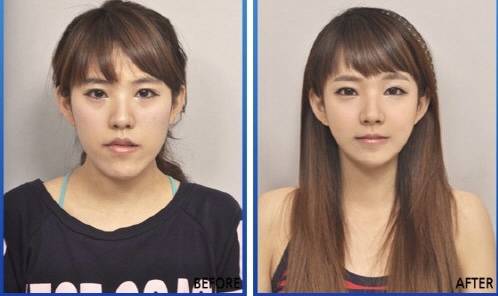 [잡담] 양악수술 후기사진들 보고 왜 하는지 이해함 | 인스티즈