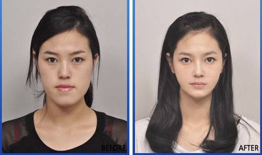 [잡담] 양악수술 후기사진들 보고 왜 하는지 이해함 | 인스티즈