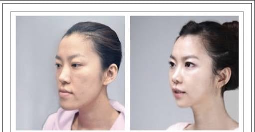[잡담] 양악수술 후기사진들 보고 왜 하는지 이해함 | 인스티즈
