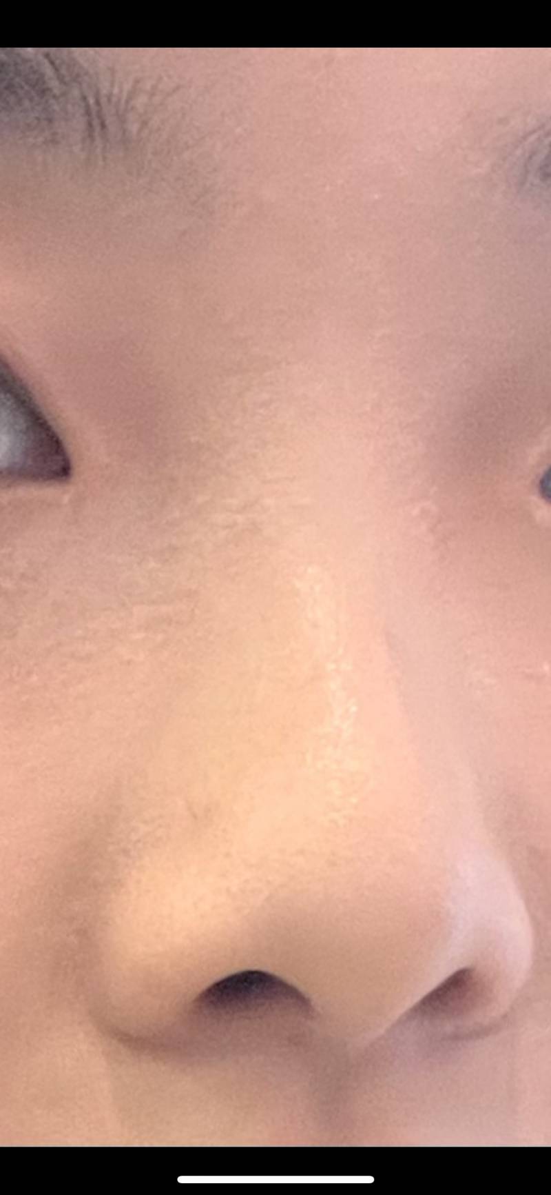 코 할까.. 코수술 무지익 도와줘ㅜㅜ | 인스티즈