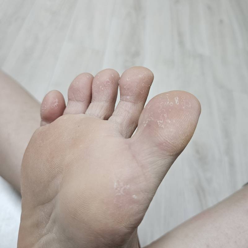 [잡담] 발이 자꾸 이렇게 껍질벗겨지는데 어케? | 인스티즈