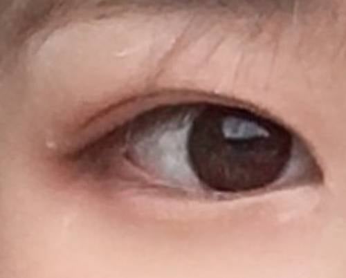 후기) 쌍수 인라인, 아웃라인 둘다해본 후기 | 인스티즈