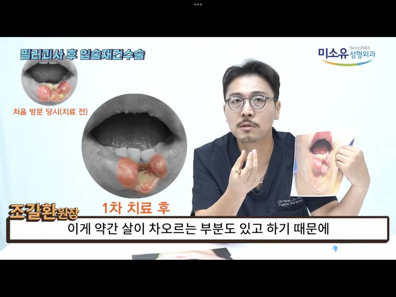 [잡담] 입술필러 맞고 싶었는데 개심각한 부작용 봄...(혐오주의) | 인스티즈