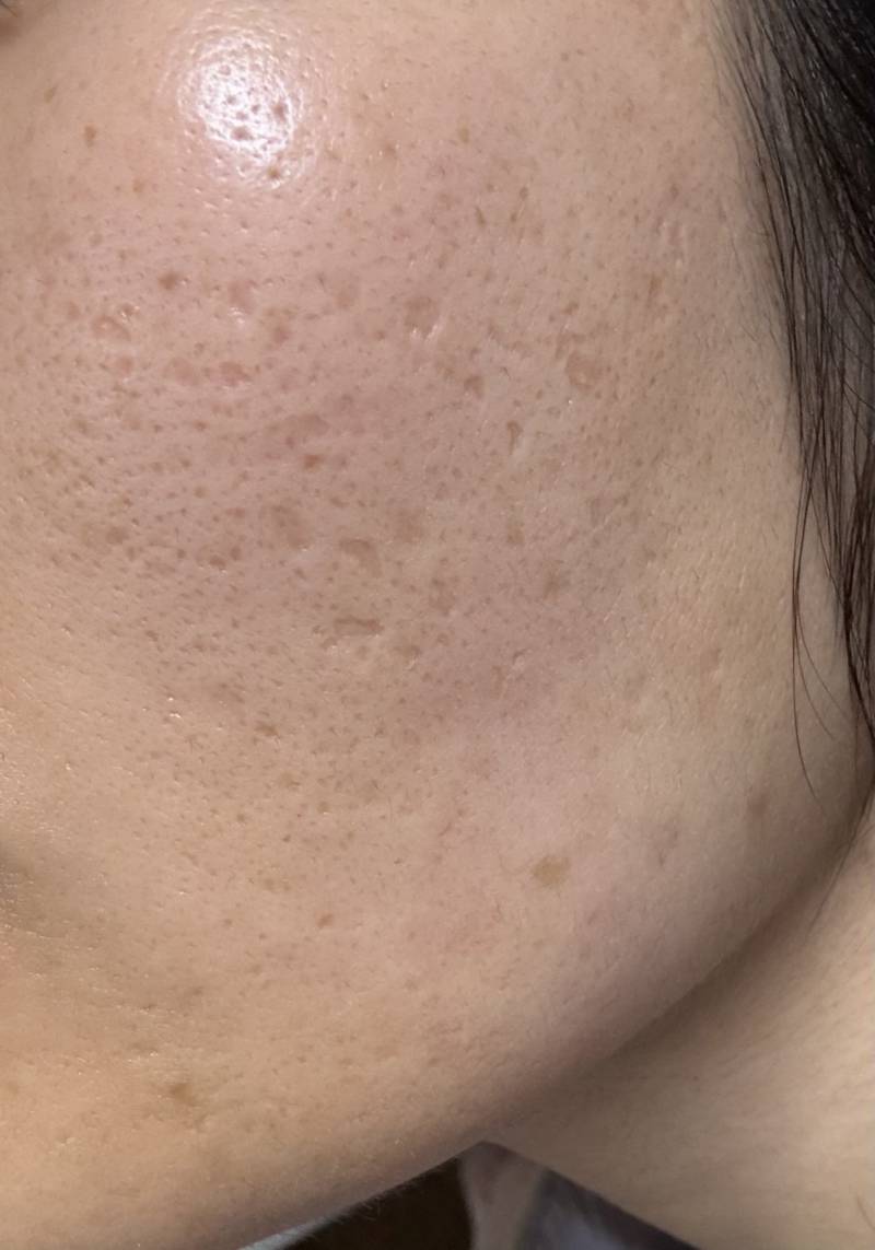 [잡담] 나 여드름 흉터땜에 프락셀 2번 받았는데 효과 있는 거 맞디?? | 인스티즈