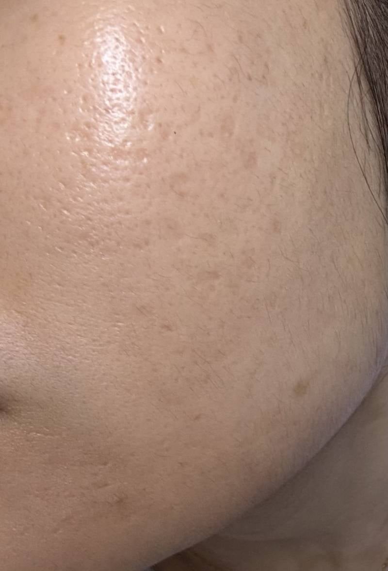 [잡담] 나 여드름 흉터땜에 프락셀 2번 받았는데 효과 있는 거 맞디?? | 인스티즈