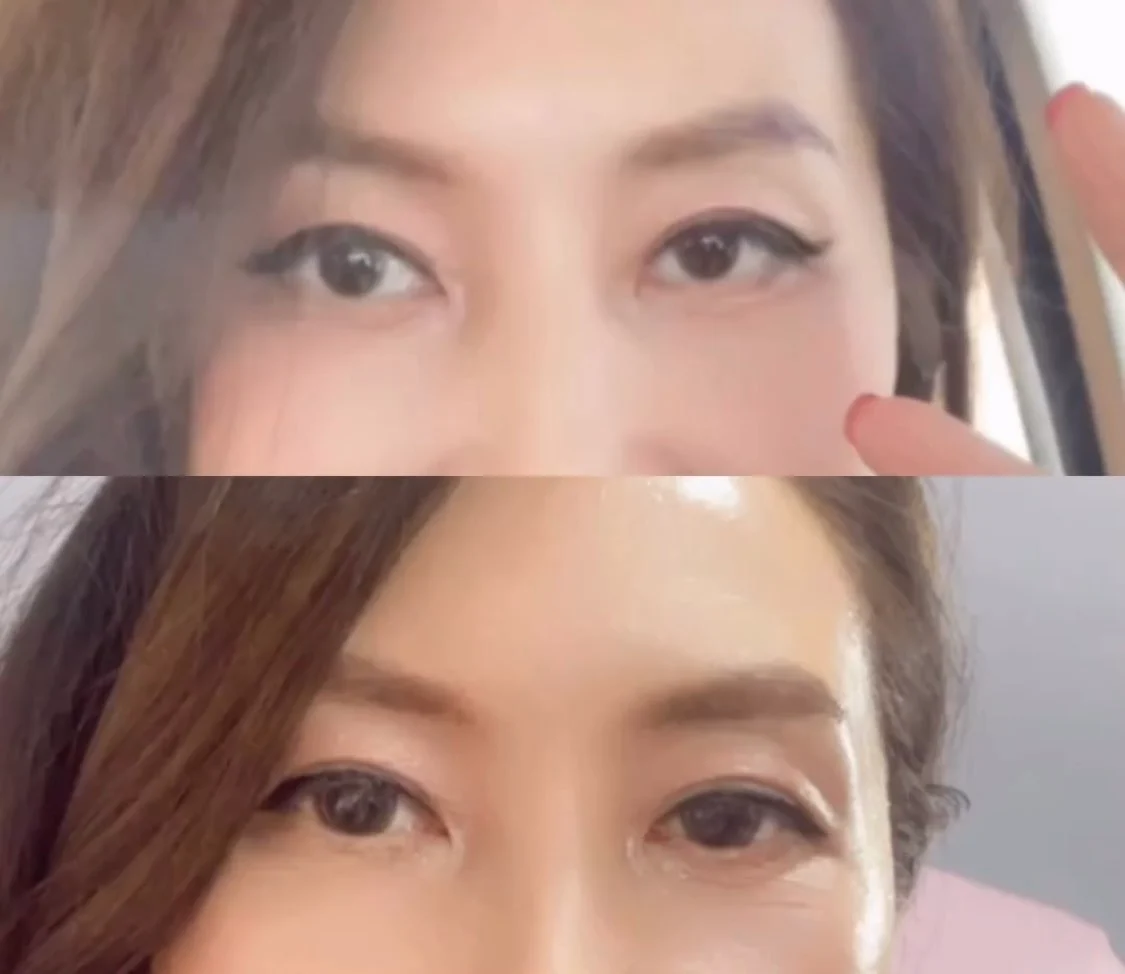 요즘 홍보중인 눈동자 성형수술...jpg | 인스티즈