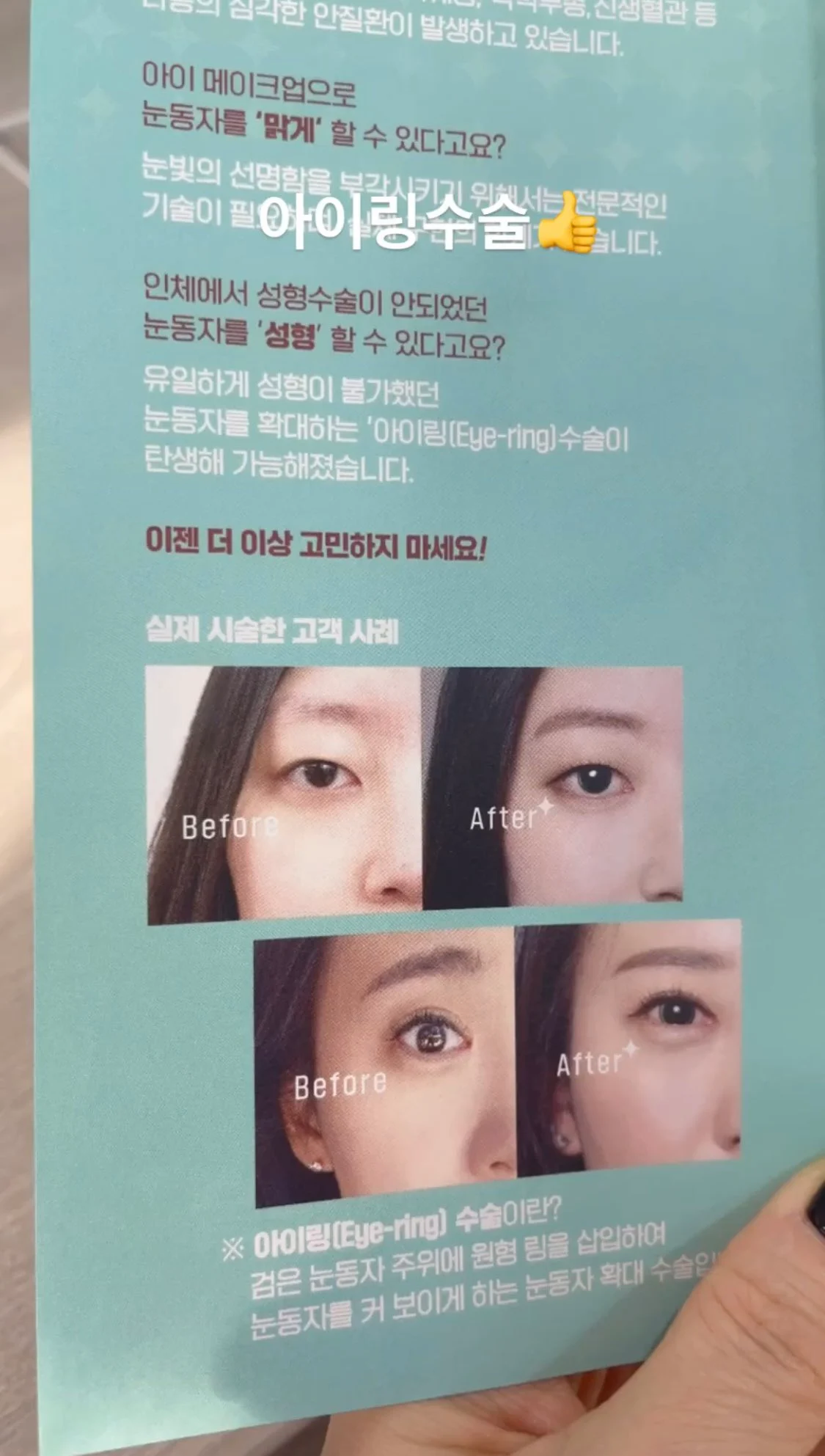 요즘 홍보중인 눈동자 성형수술...jpg | 인스티즈