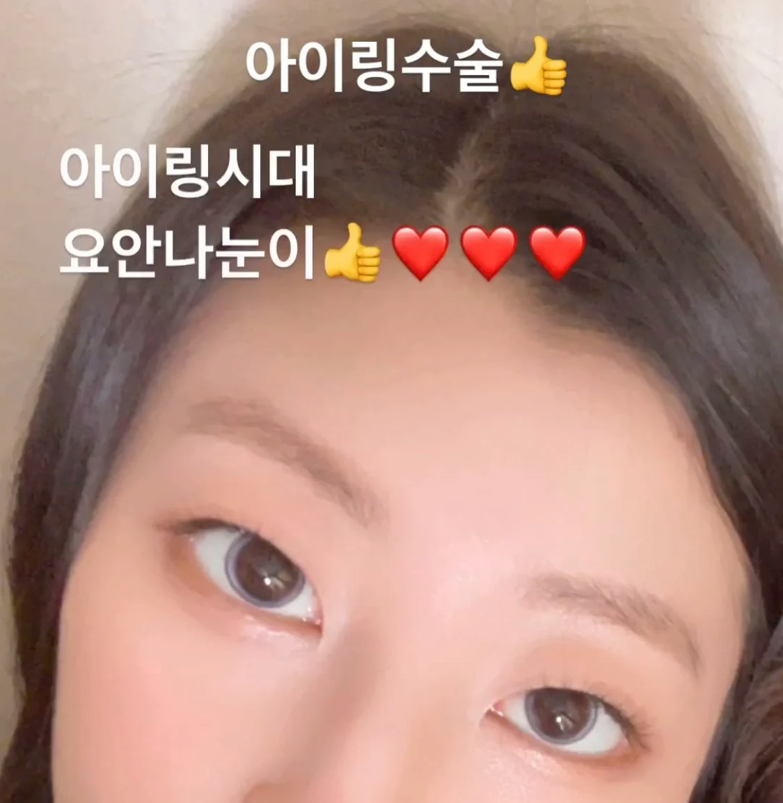요즘 홍보중인 눈동자 성형수술...jpg | 인스티즈
