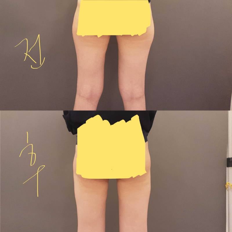 [잡담] 지방추출주사 1년차 사진변화💉 | 인스티즈