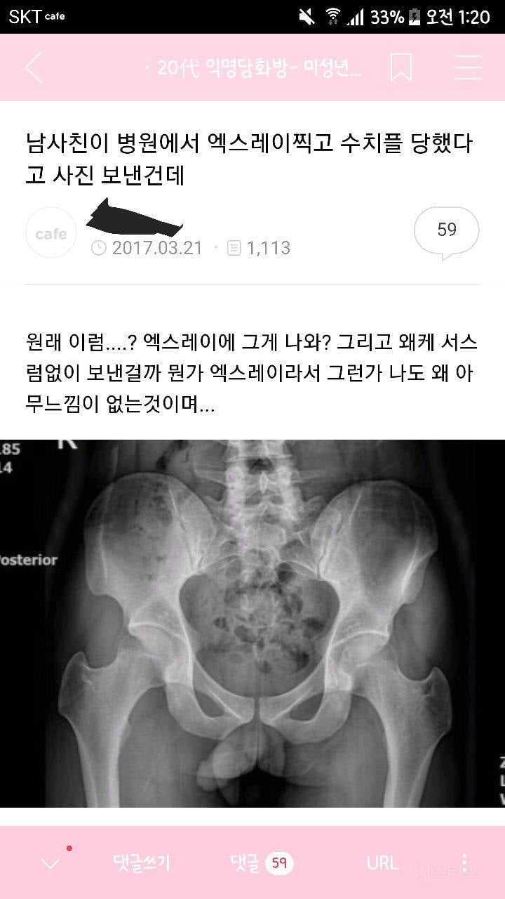 골반 엑스레이 찍고 수치플 당한 남사친.jpg | 인스티즈