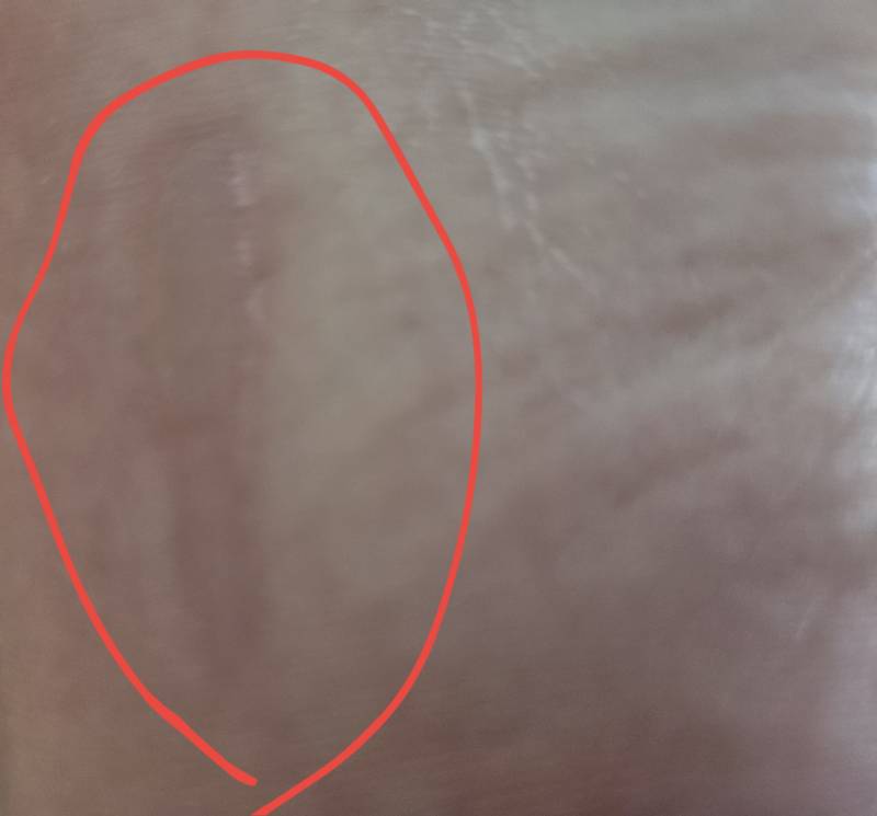 [잡담] 발바닥 물집 터뜨려야 할까?(발사진 주의) | 인스티즈
