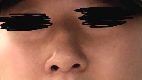 [잡담] (고민)눈 밑에 앞광대뼈?? 어떡해… 너구리같아.. | 인스티즈