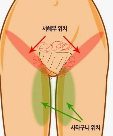 [잡담] 비키니라인 레이저 제모 처음인데 도움 좀 주라 ㅜㅜ | 인스티즈