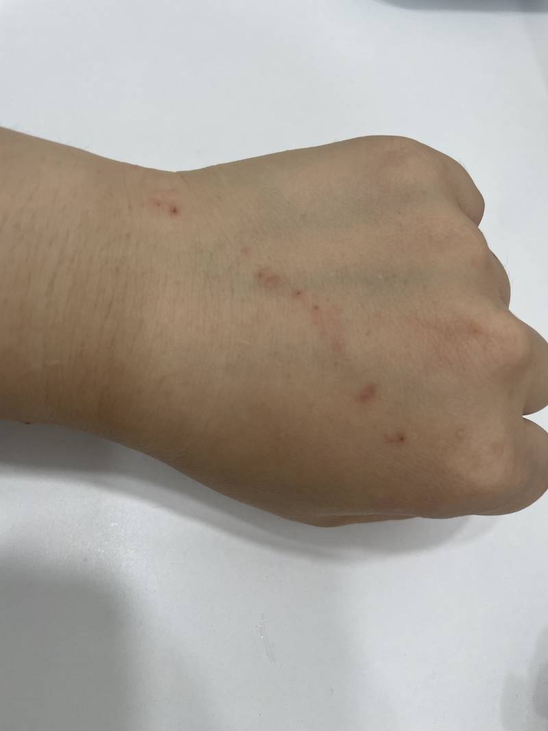 [잡담] 손등에 이렇게 길게 뭐가 나고 가려운데 뭘까?ㅠ(혐) | 인스티즈