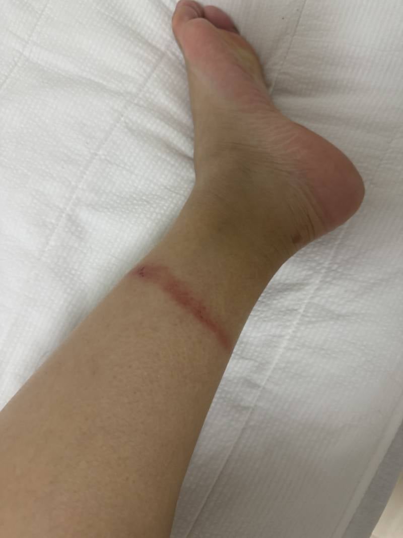 [잡담] 혹시 슬리퍼나 장화같은거 신으면 피부 가려운익 없어?? 내 다리 어떻게해.... (혐오주의) | 인스티즈