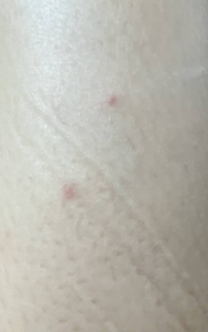 [잡담] 팔이나 다리에 붉은 반점 나는 익 혹시 있니 ㅠㅠ | 인스티즈