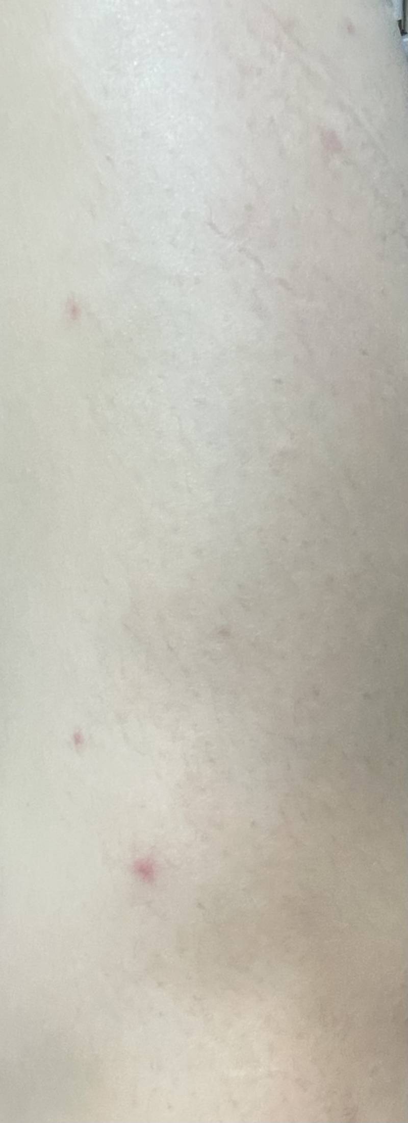 [잡담] 팔이나 다리에 붉은 반점 나는 익 혹시 있니 ㅠㅠ | 인스티즈