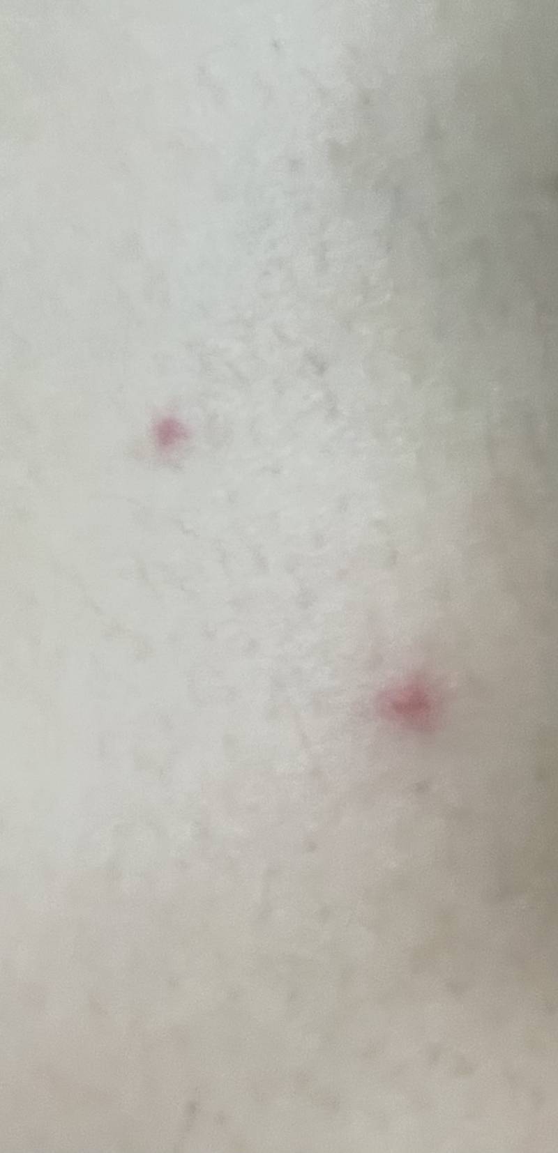 [잡담] 팔이나 다리에 붉은 반점 나는 익 혹시 있니 ㅠㅠ | 인스티즈