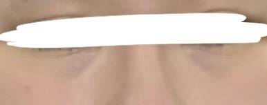 [잡담] 익들아 이 정도 다크서클이면 눈밑필러 맞아야겠지??? | 인스티즈