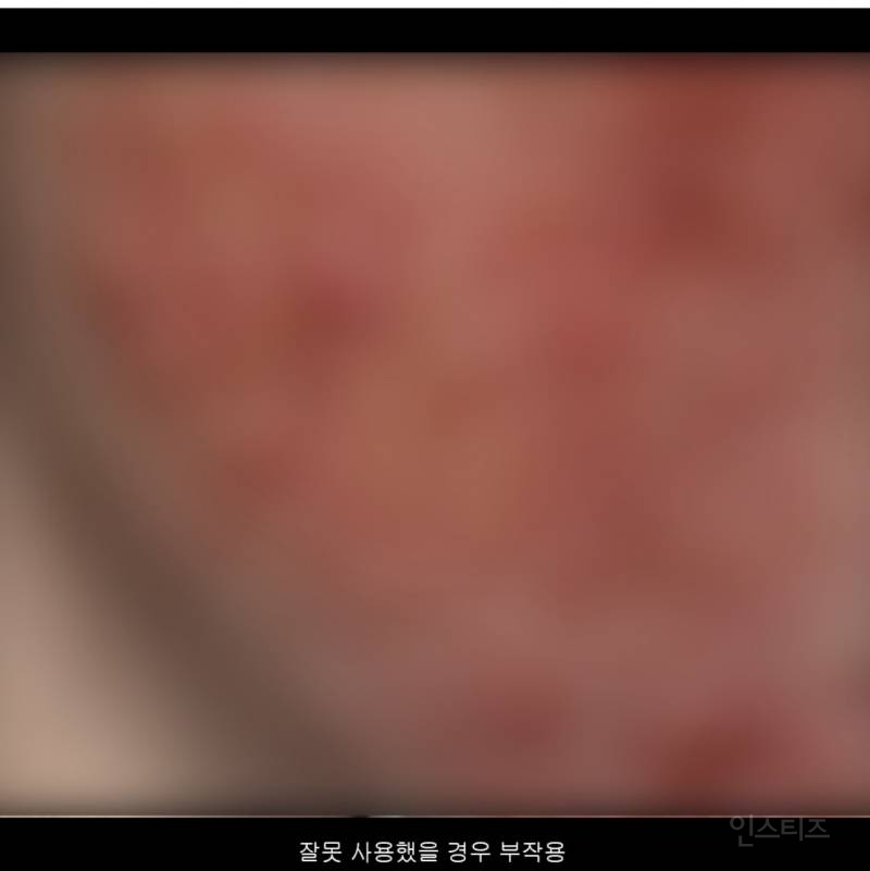 약사가 말하는 스피큘에 얼굴 갈리는 이유.JPG | 인스티즈