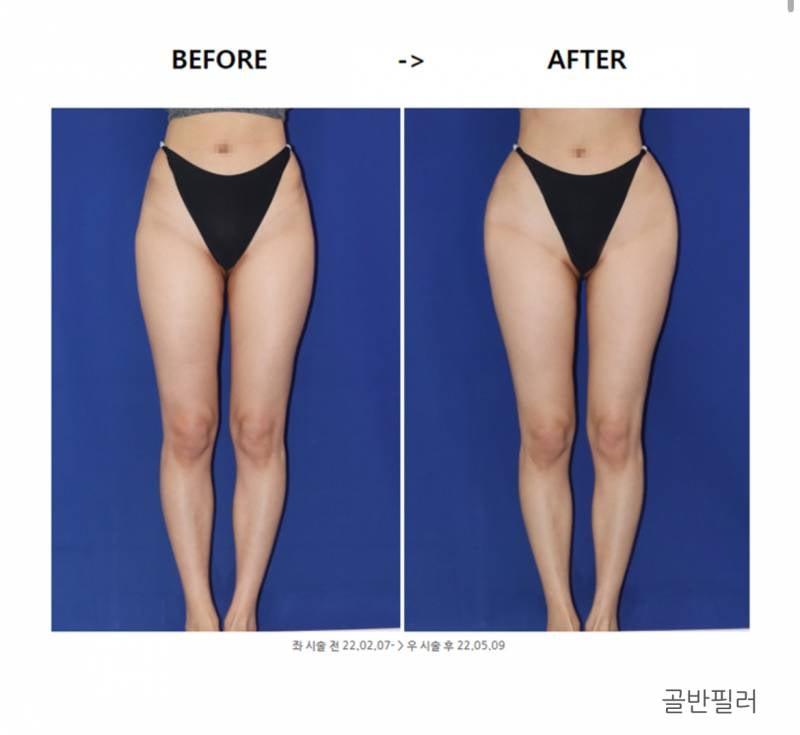 [잡담] 골반필러로 뭐 얼마나 커지길래 검색해봤는데(ㅎㅂㅈㅇ) | 인스티즈