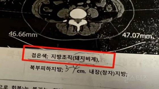 CT 결과지에 '돼지비계' 적어놓고…의사 "기분 나쁘면 오지마" | 인스티즈