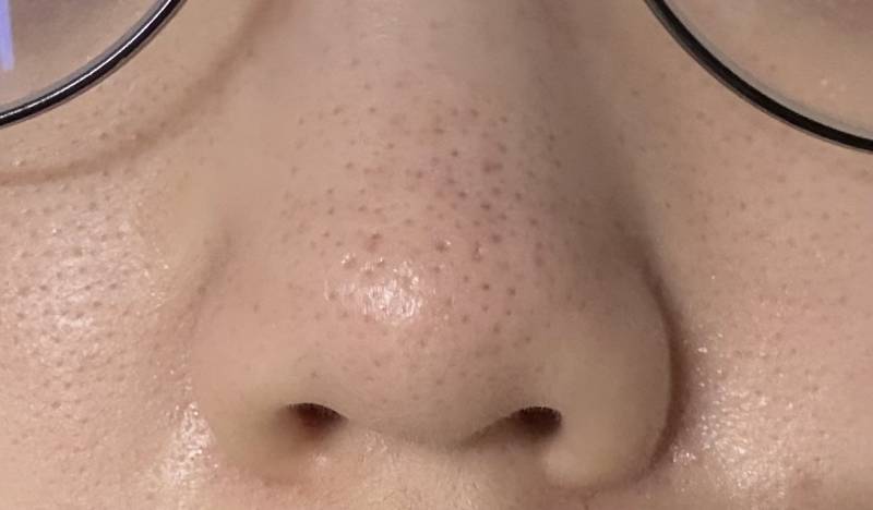 [잡담] 아니 나 코+나비존 모공 엄청 심한편이지?.. | 인스티즈