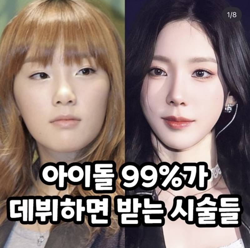 [잡담] 태연 이거 시술 뭐한거야? | 인스티즈