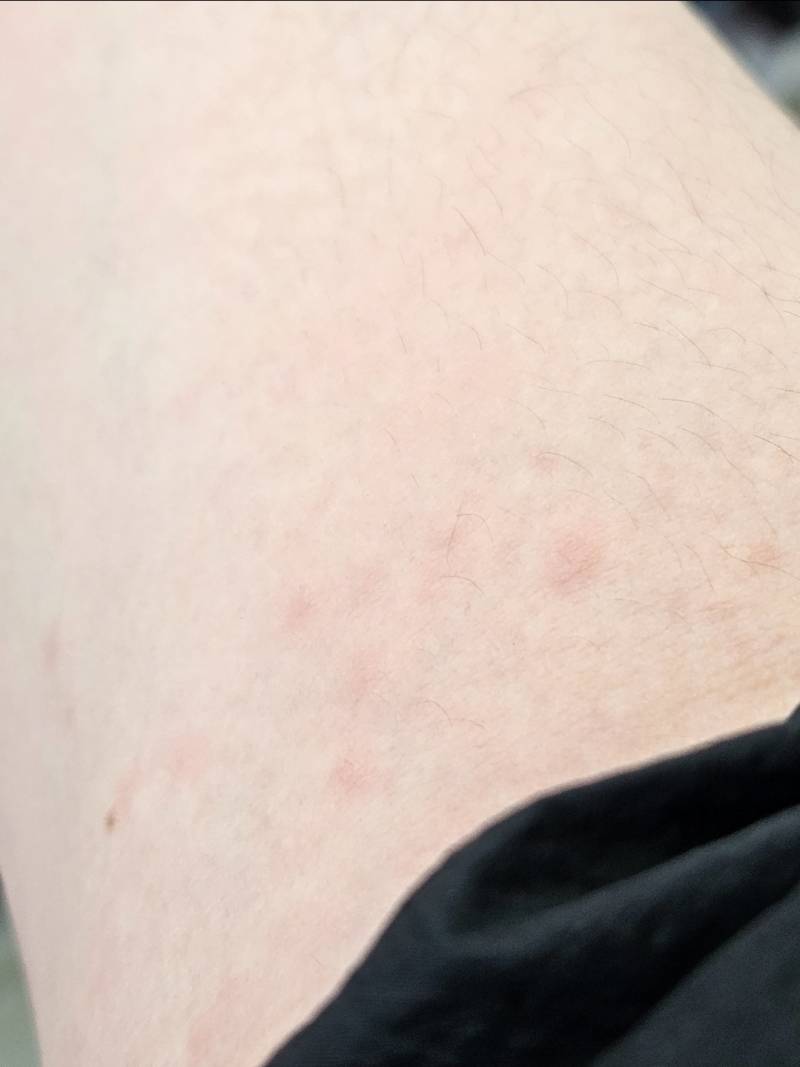 [잡담] 팔에 이런식으로 빨간점이 생겼는데 뭘까??? (혐) | 인스티즈